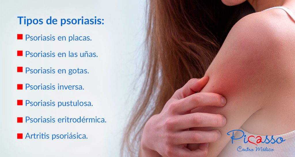 tipos psoriasis