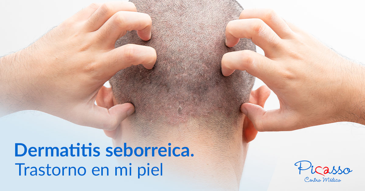 Dermatitis seborreica. en mi piel