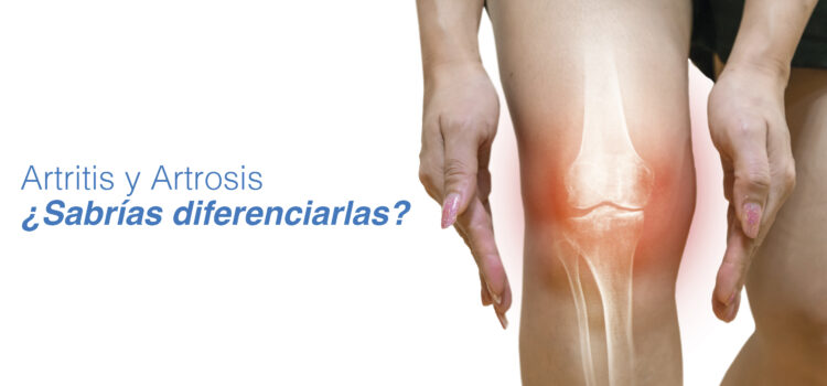 Principales diferencias entre artritis y artrosis