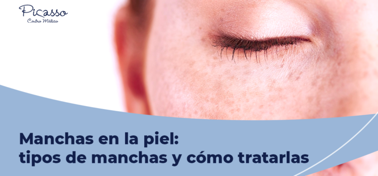 Tipos de manchas en la piel: diagnóstico y cómo tratarlas